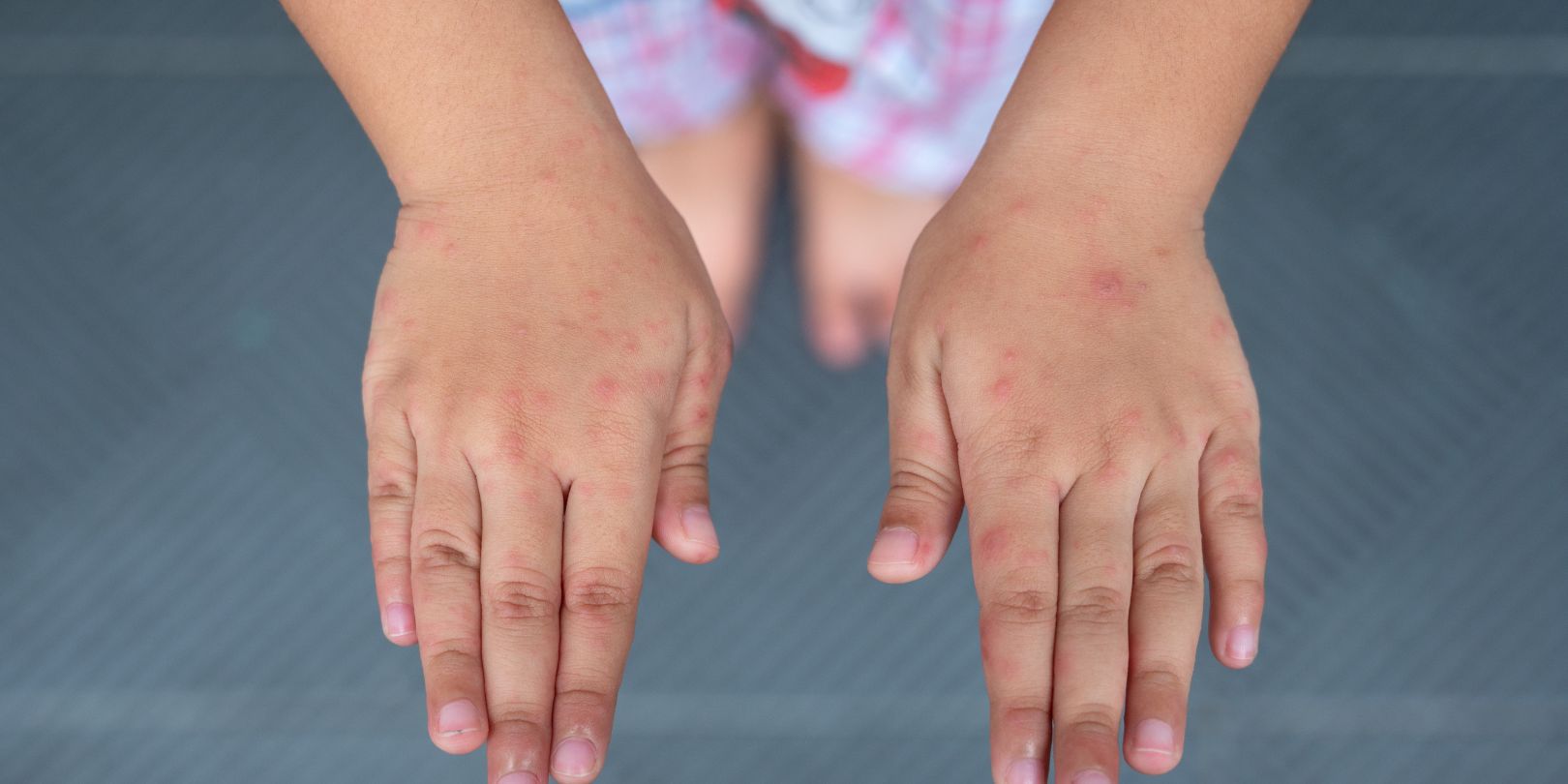 diaper-rash-vs-hand-foot-mouth mighty-moms Rash on the hands of the Hand foot and mouth disease. Hand-foot-and-mouth disease is most commonly caused by a coxsackievirus and Enterovirus.
